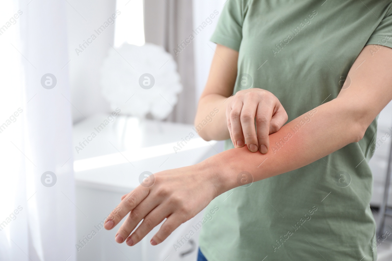 Photo of Woman with allergy symptoms scratching forearm indoors, closeup. Space for text