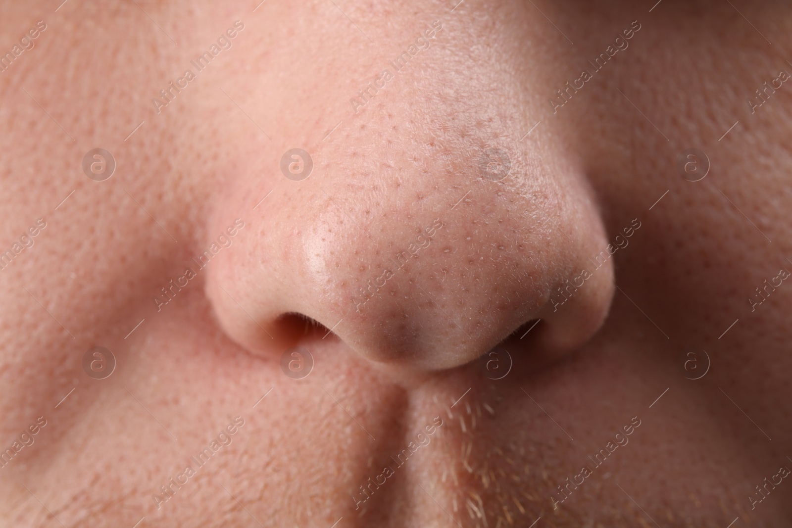 Photo of Young man with acne problem, closeup view of nose