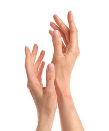 Image of Young woman with dry skin on white background, closeup of hands