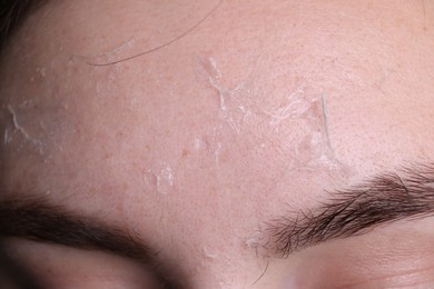 Photo of Woman with dry skin on forehead, macro view