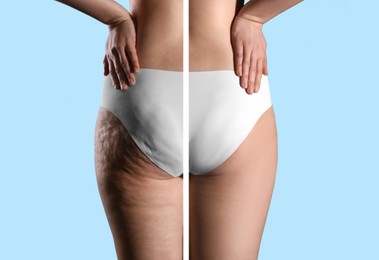 Image of Collage with photos of woman before and after anti cellulite treatment on light blue background, 