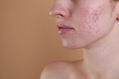 Young woman with acne problem on beige background, closeup. Space for text