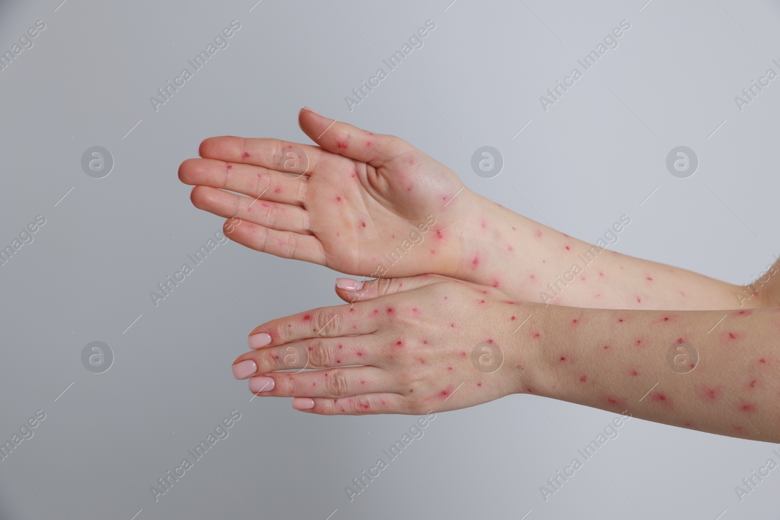 Photo of Woman with rash suffering from monkeypox virus on light grey background, closeup