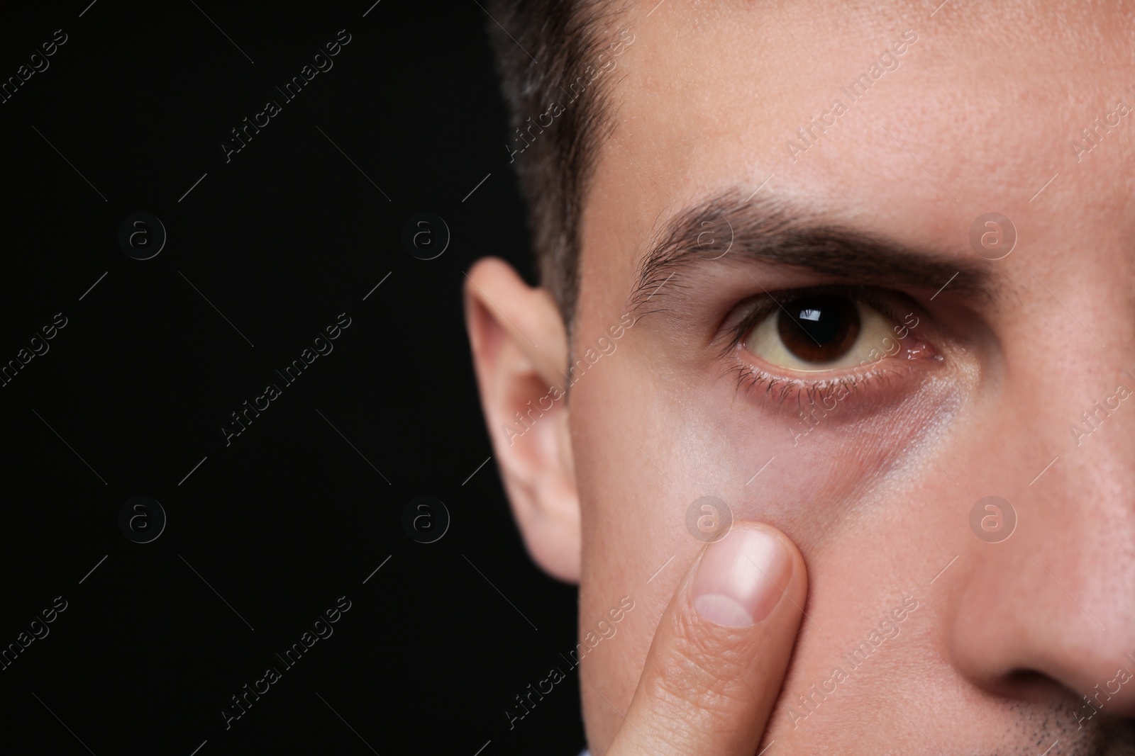 Photo of Man checking his health condition on black background, closeup and space for text. Yellow eyes as symptom of problems with liver