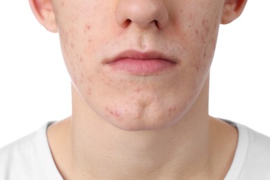 Young man with acne problem isolated on white, closeup