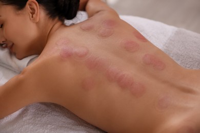 Closeup view of woman after cupping therapy indoors