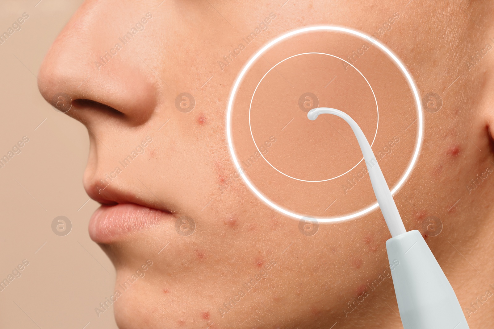 Image of Teenage boy before and after using darsonval on beige background, closeup