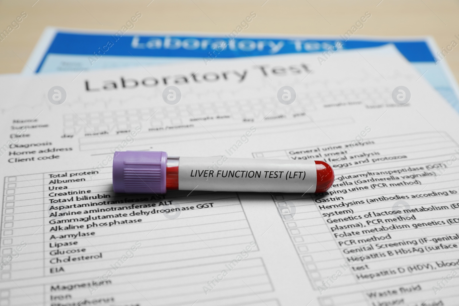 Photo of Liver Function Test. Tube with blood sample and laboratory forms on table