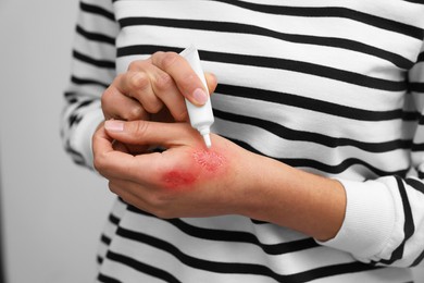 Woman applying healing cream onto burned hand on light grey background, closeup