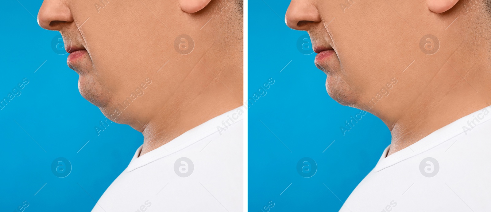 Image of Mature man before and after plastic surgery operation on blue background, closeup. Double chin problem