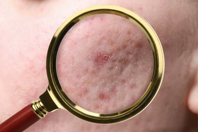 Dermatology. Woman with skin problem, closeup. View through magnifying glass on acne