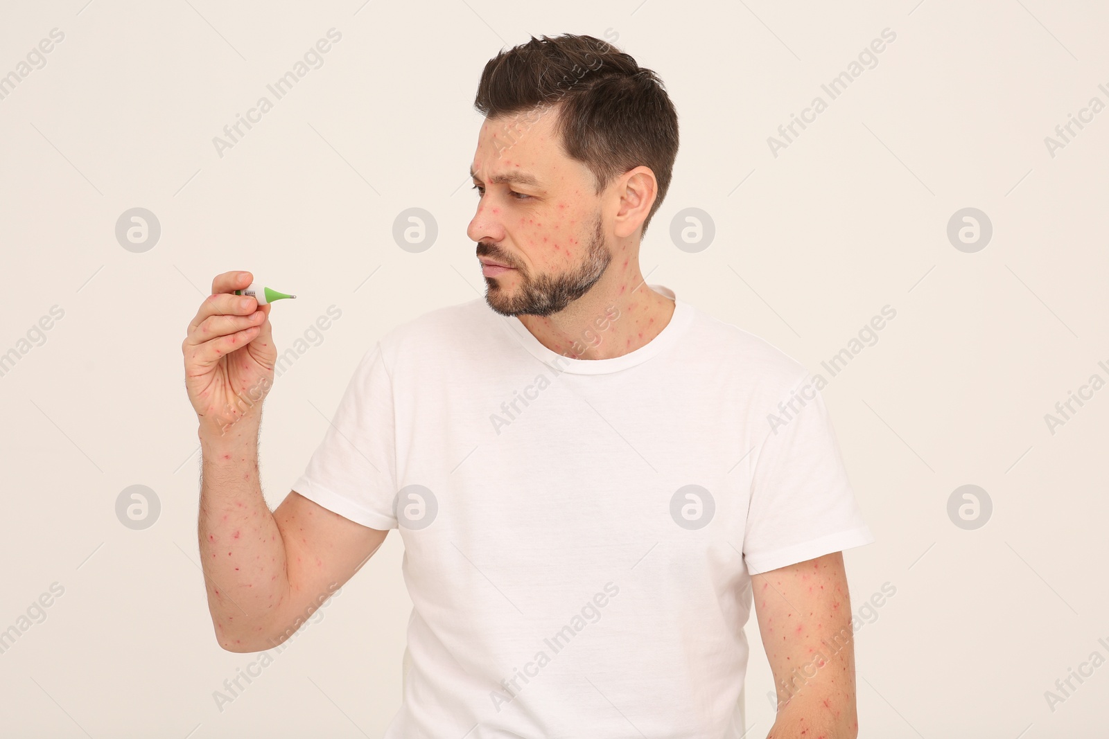 Photo of Man with rash holding thermometer on beige background. Monkeypox virus diagnosis