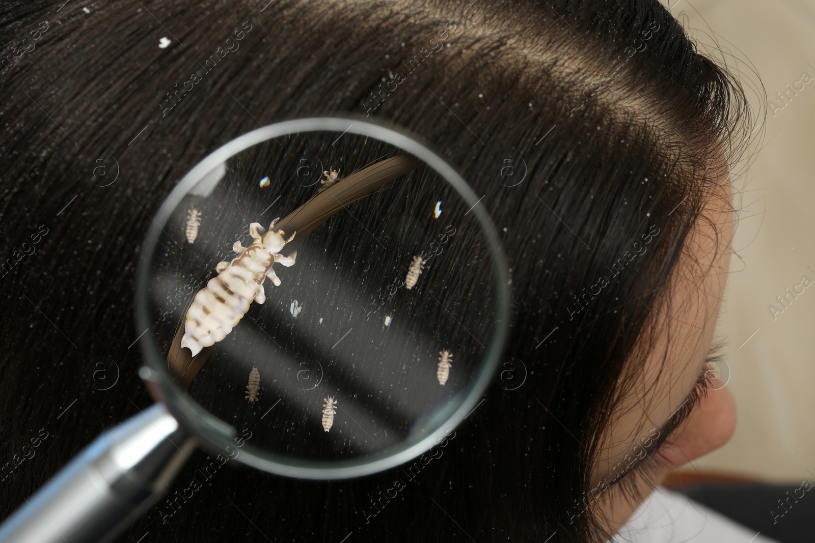 Image of Pediculosis. Woman with lice and nits, closeup. View through magnifying glass on hair