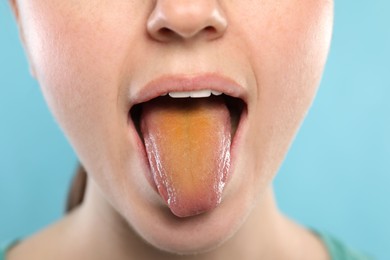Photo of Gastrointestinal diseases. Woman showing her yellow tongue on light blue background, closeup