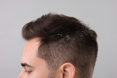 Man with dandruff in his dark hair on light grey background, closeup