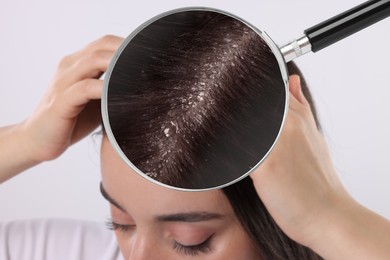 Woman suffering from dandruff on light background, closeup. View through magnifying glass on hair with flakes