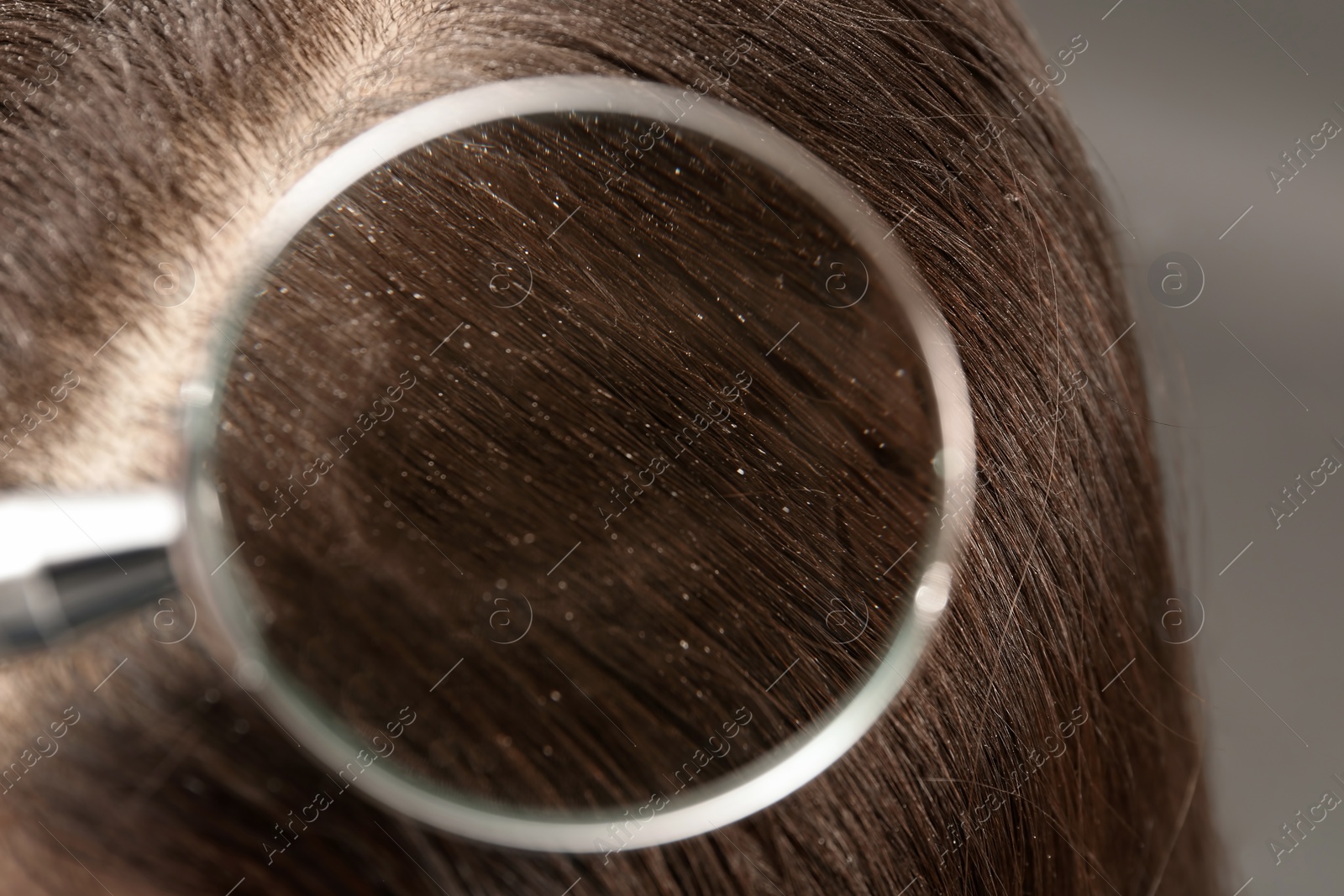 Photo of Closeup of woman with dandruff in her hair, view through magnifying glass