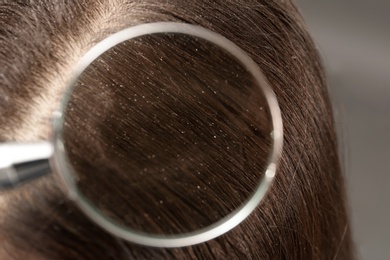 Photo of Closeup of woman with dandruff in her hair, view through magnifying glass