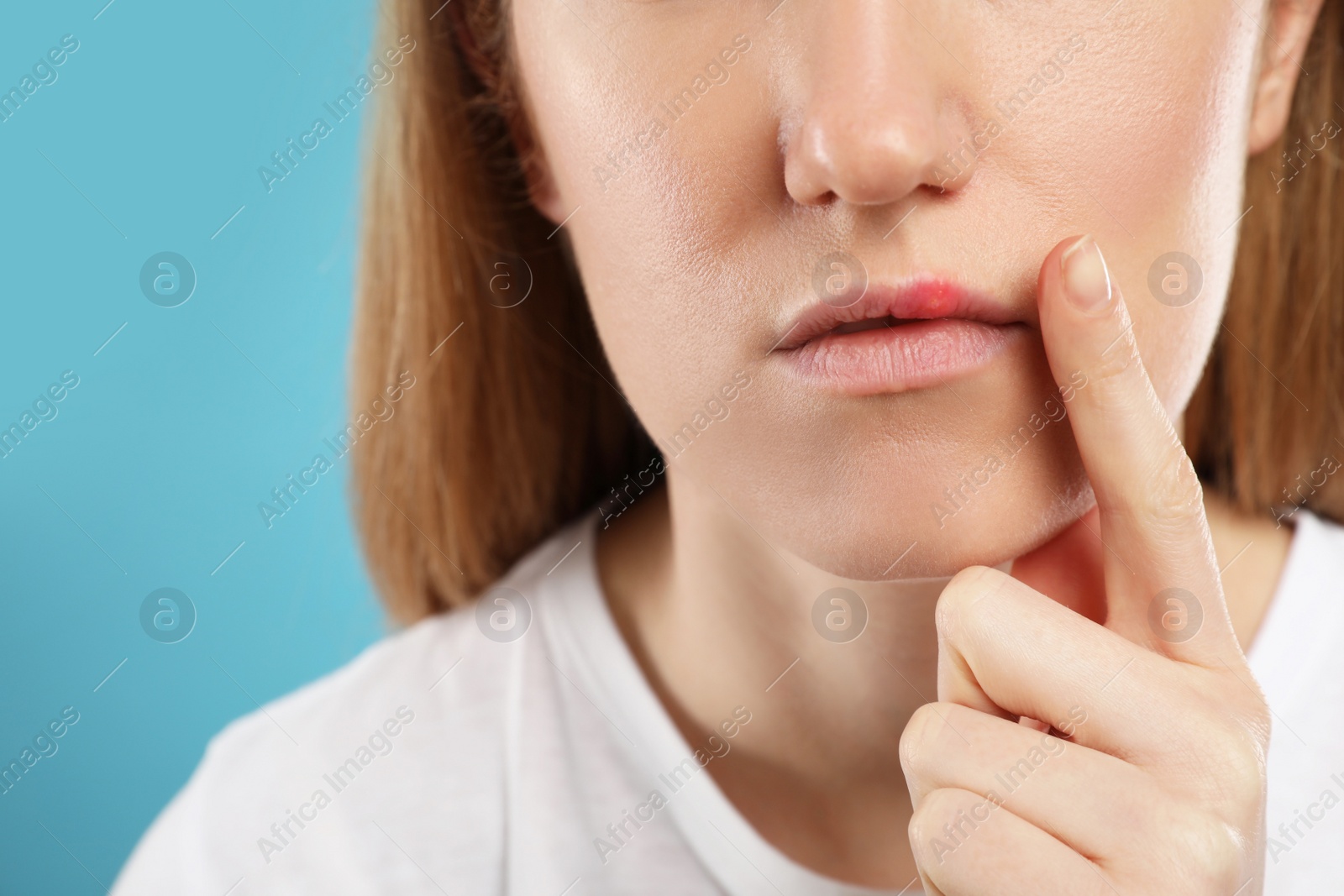 Photo of Woman suffering from herpes on light blue background, closeup