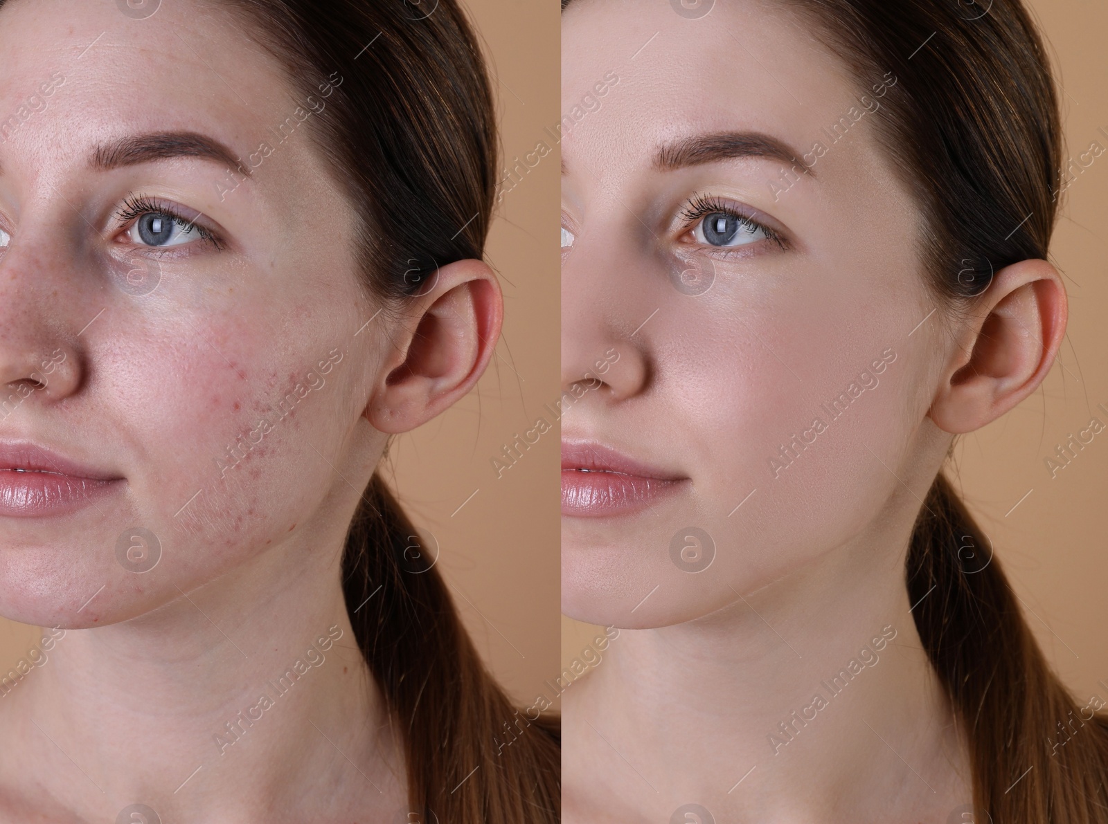 Image of Acne problem. Young woman before and after treatment on beige background, collage of photos
