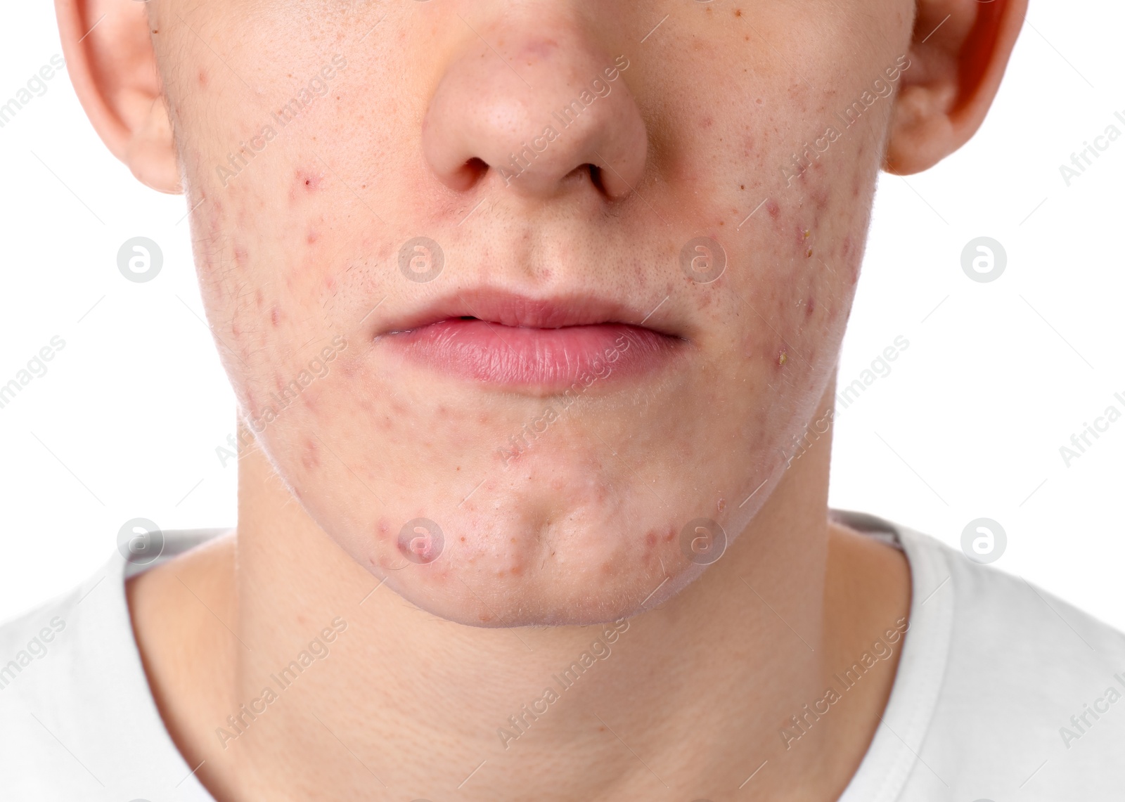 Photo of Young man with acne problem isolated on white, closeup