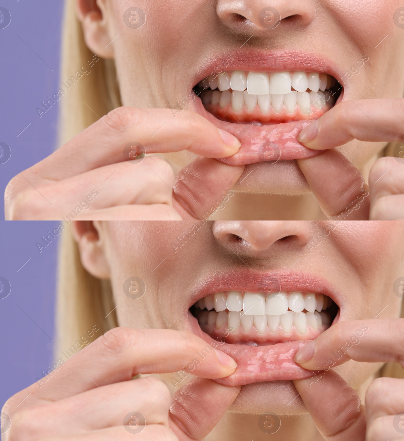 Image of Woman showing gum before and after treatment on purple background, collage of photos