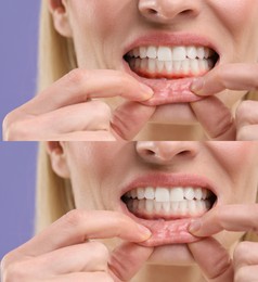 Image of Woman showing gum before and after treatment on purple background, collage of photos