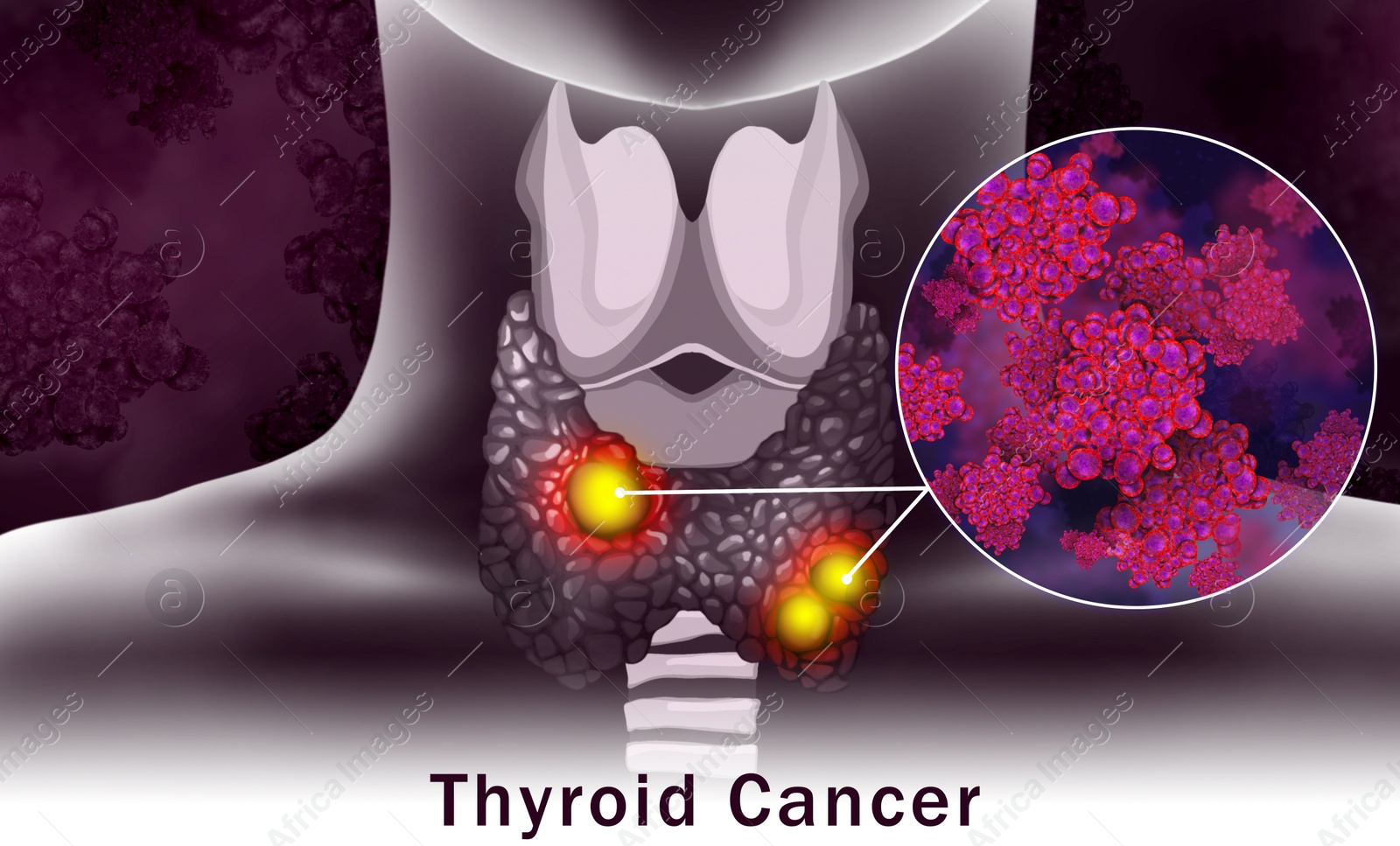 Illustration of  human thyroid cancer on color background