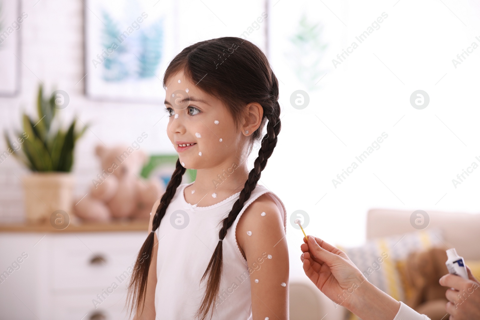 Photo of Mother applying cream onto skin of her daughter with chickenpox at home