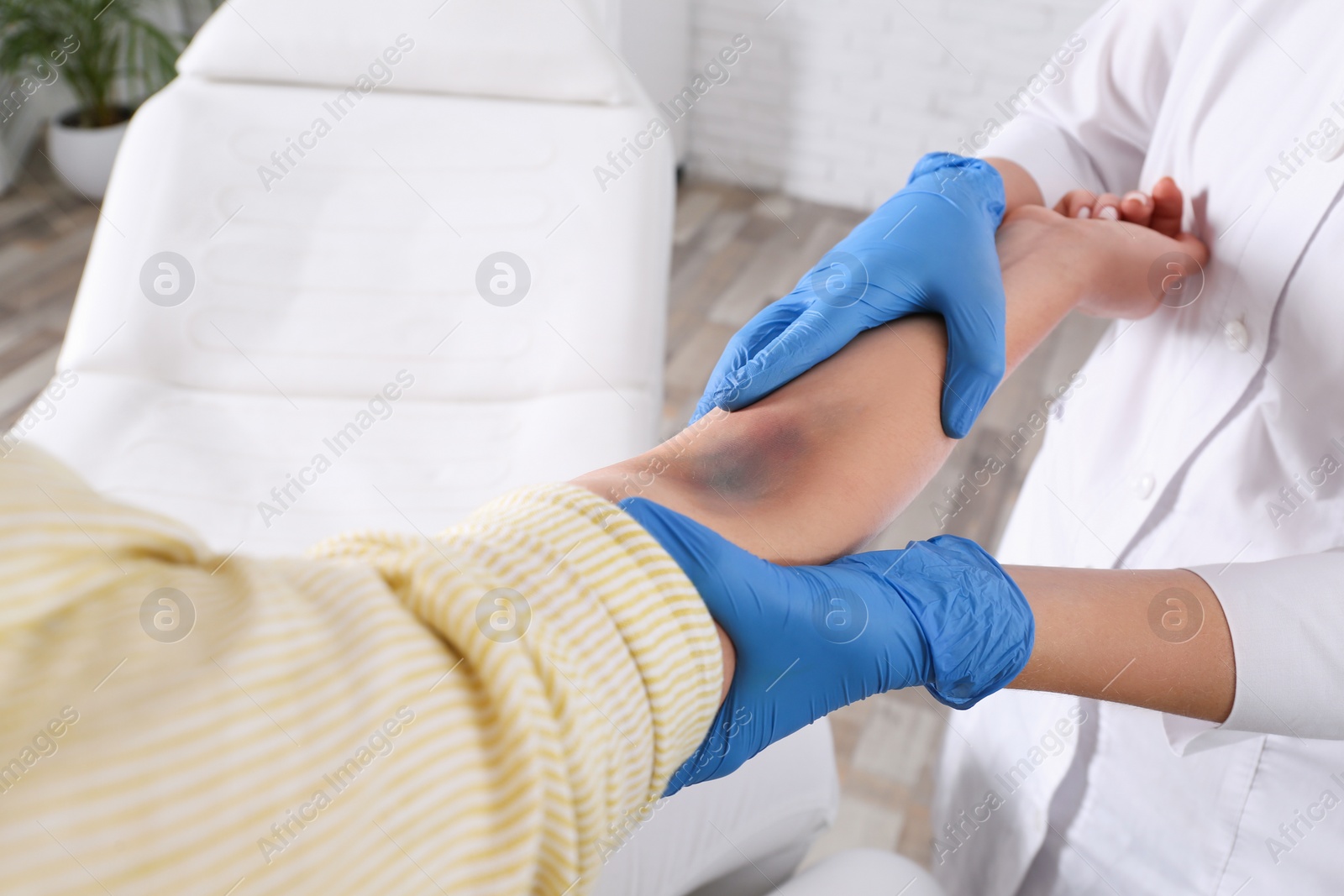 Photo of Doctor checking woman's elbow with bruise at hospital, closeup