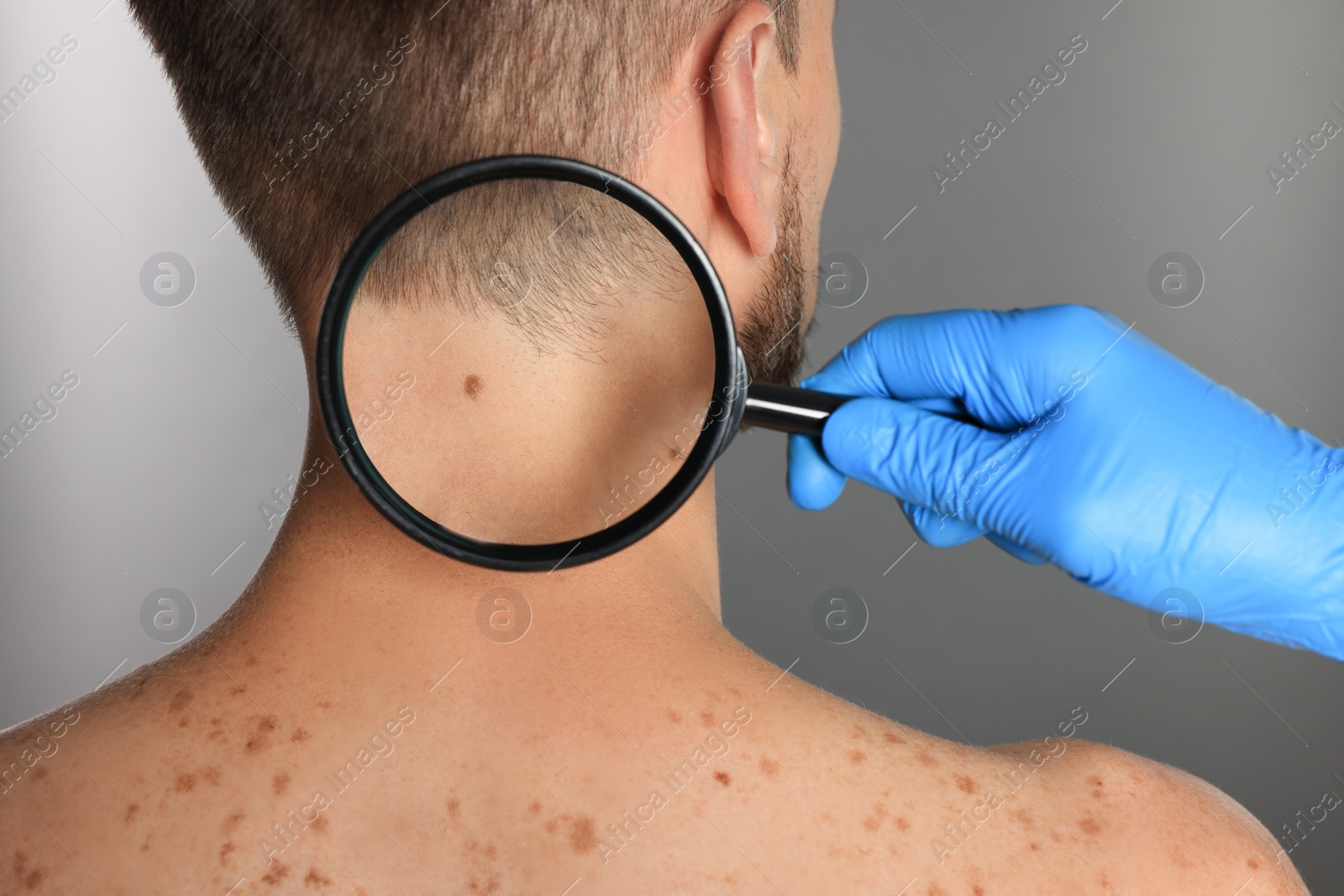 Photo of Dermatologist examining patient's birthmark with magnifying glass on grey background, closeup