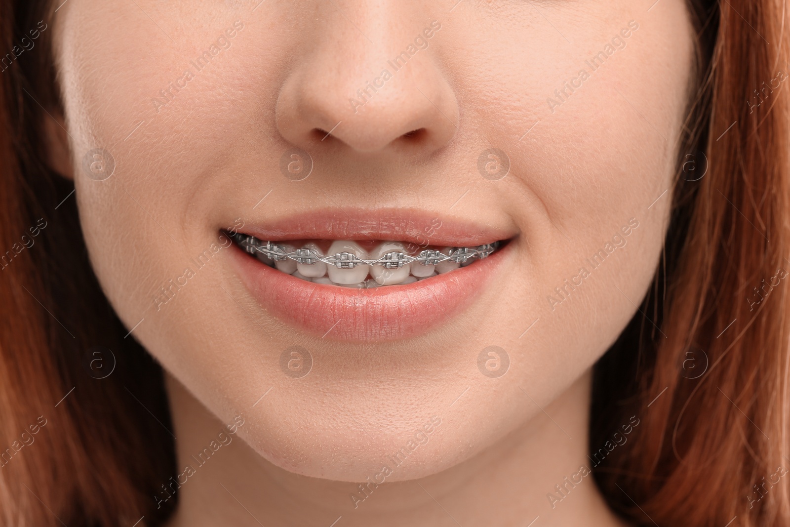 Photo of Smiling woman with dental braces, closeup view