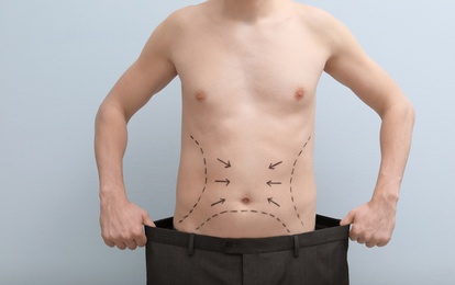 Photo of Young man with marks on belly for cosmetic surgery operation on light background