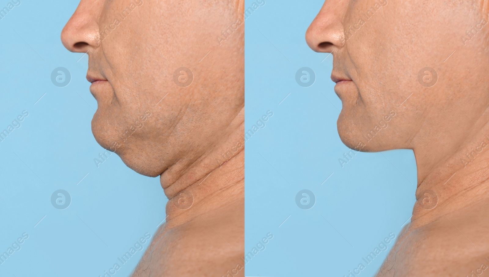 Image of Mature man before and after plastic surgery operation on blue background, closeup. Double chin problem