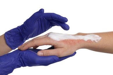 Photo of Doctor applying panthenol onto patient's burned hand on white background, closeup
