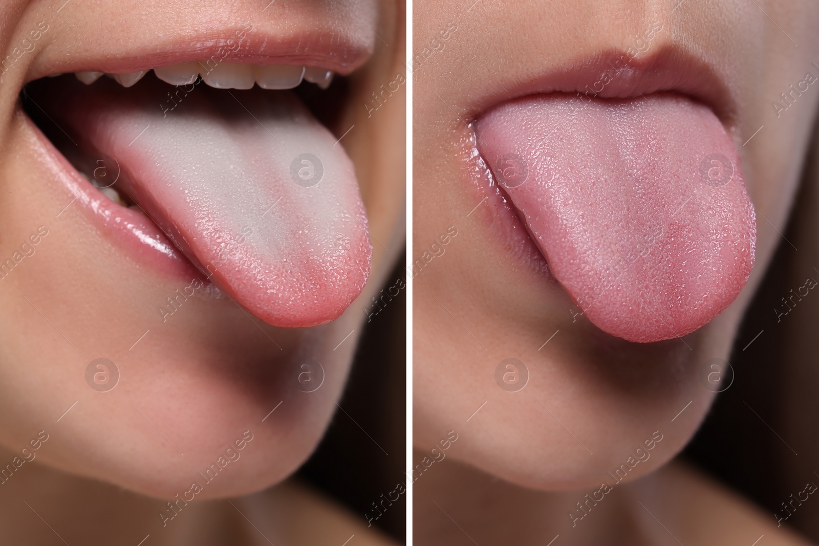 Image of Woman showing her tongue before and after cleaning procedure, closeup. Tongue coated with plaque on one side and healthy on other, collage