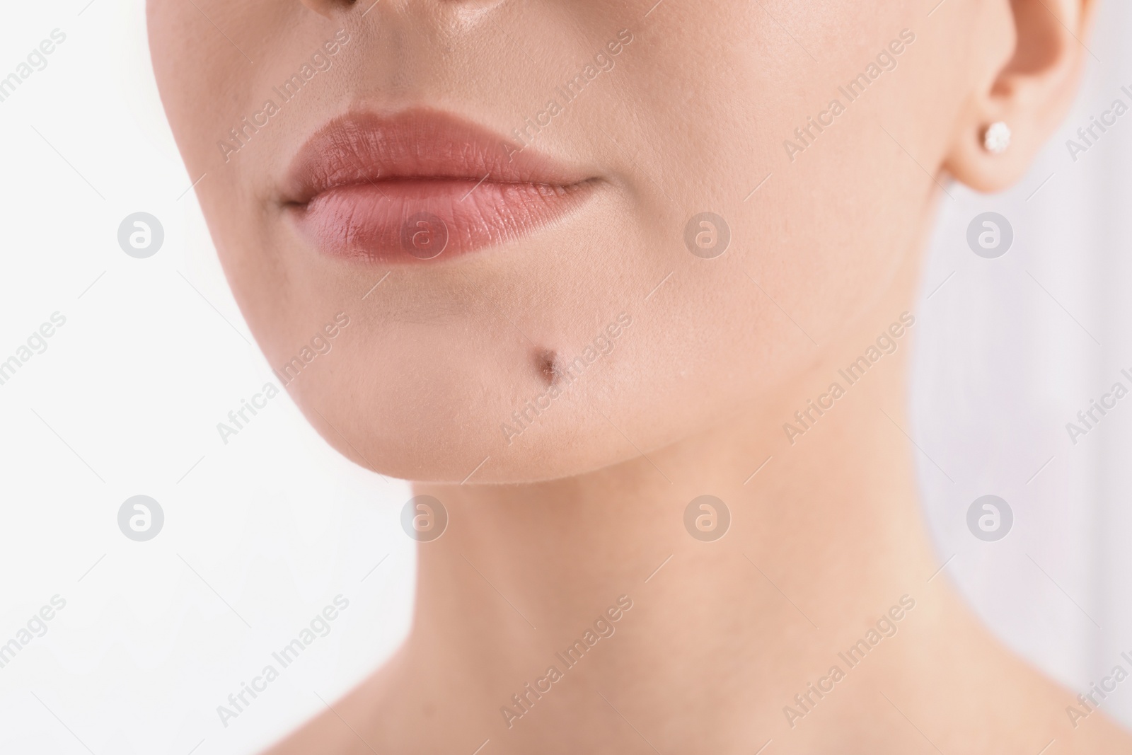 Photo of Young woman with birthmark in clinic, closeup view. Visiting dermatologist