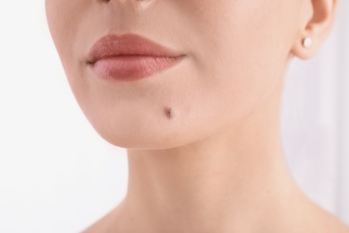 Photo of Young woman with birthmark in clinic, closeup view. Visiting dermatologist