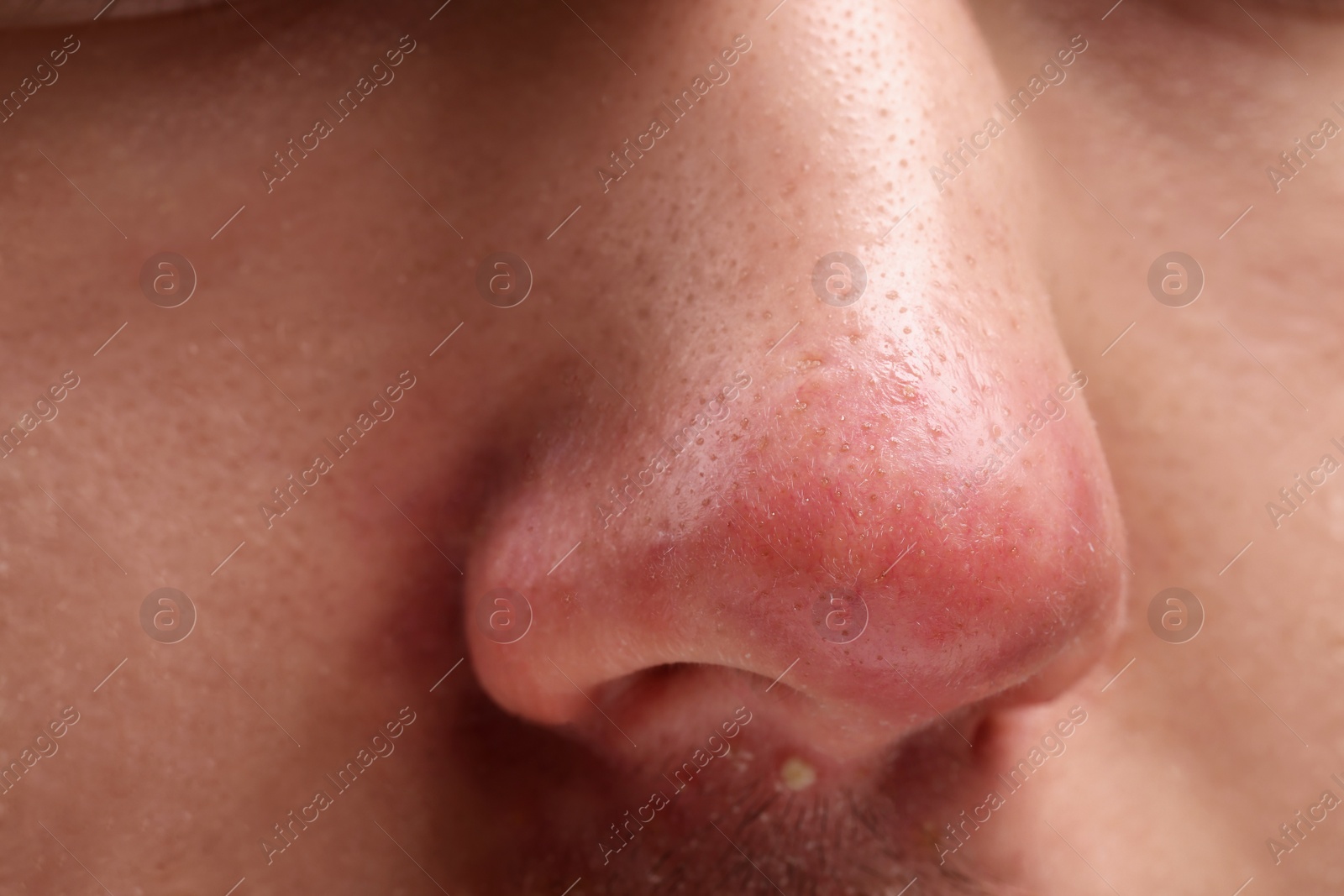 Photo of Young man with acne problem, closeup view of nose