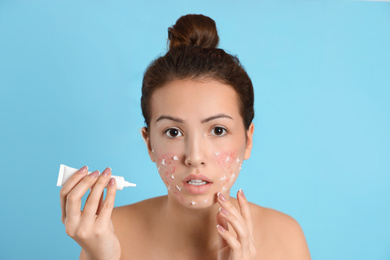 Photo of Teen girl with acne problem applying cream on light blue background