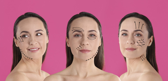 Image of Photos of mature woman with lifting marks on face against pink background, collage. Cosmetic surgery