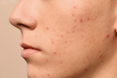 Photo of Teen guy with acne problem on beige background, closeup