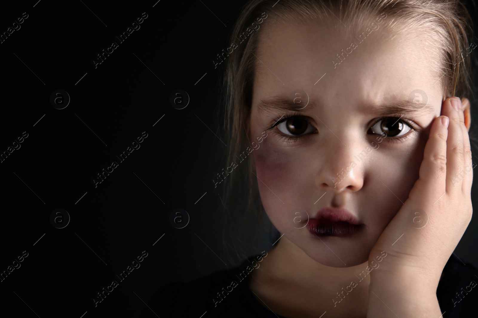 Photo of Little girl with bruises on face against dark background, space for text. Domestic violence victim