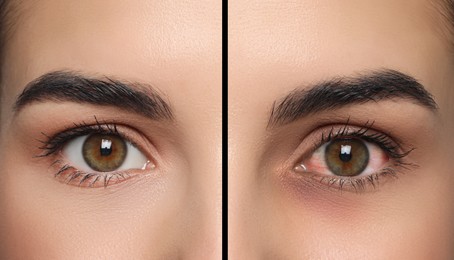 Image of Collage with photos of woman with inflamed and healthy eyes before and after treatment, closeup
