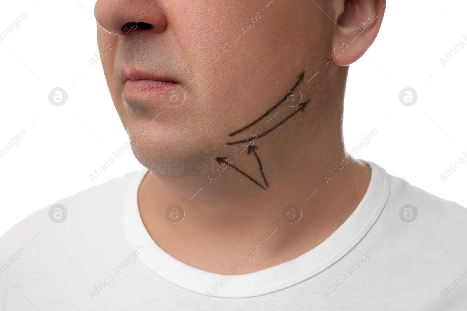 Photo of Mature man with marks on face against white background, closeup. Double chin removal