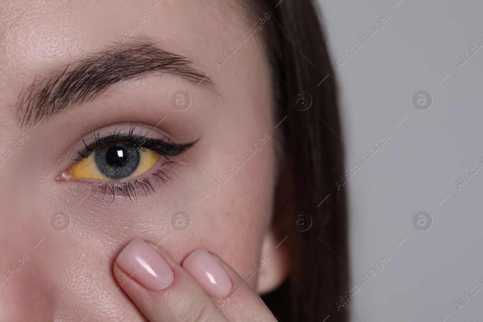 Photo of Woman with yellow eyes on light grey background, closeup. Symptom of hepatitis