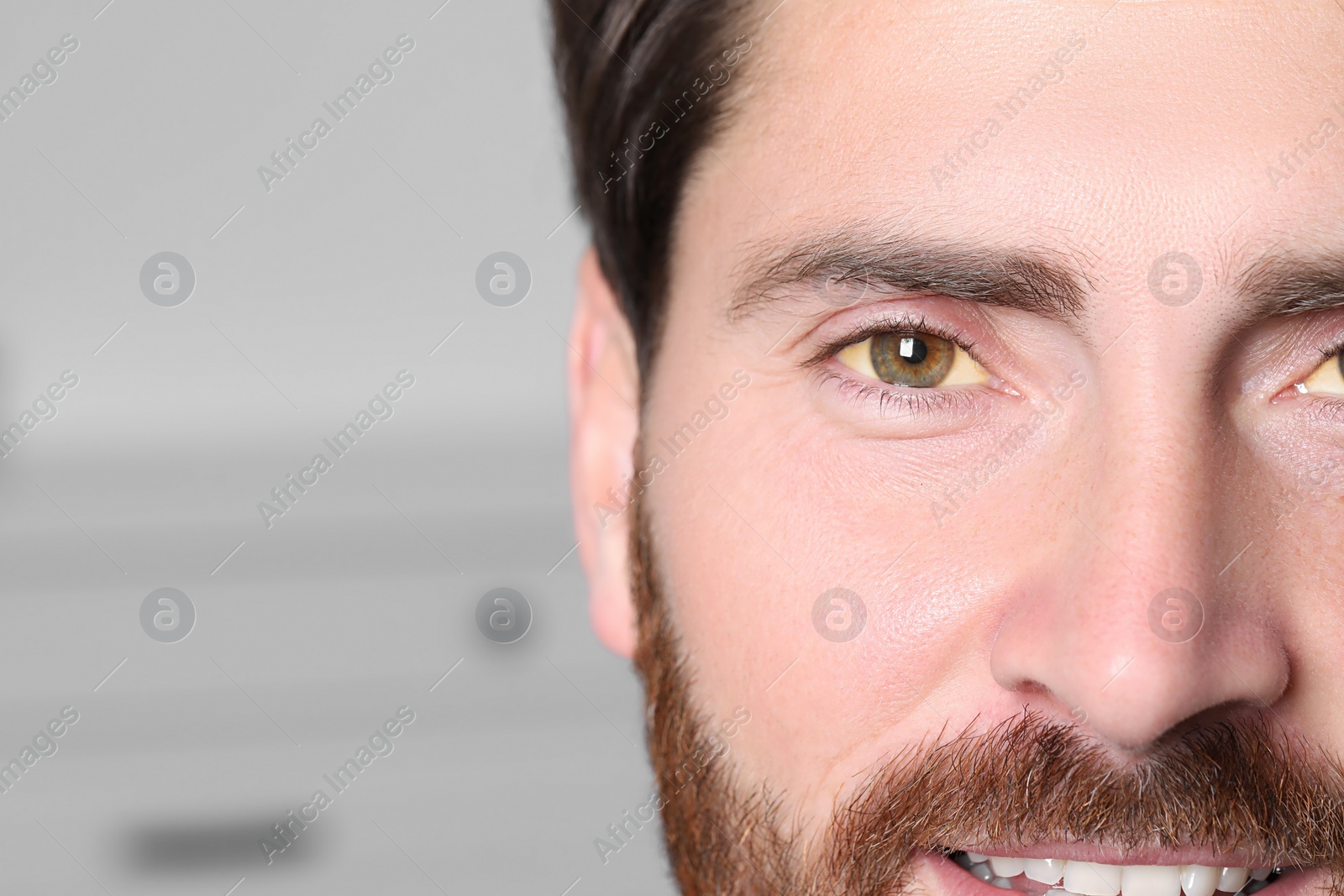 Photo of Man with yellow eyes on blurred background, closeup. Symptom of hepatitis