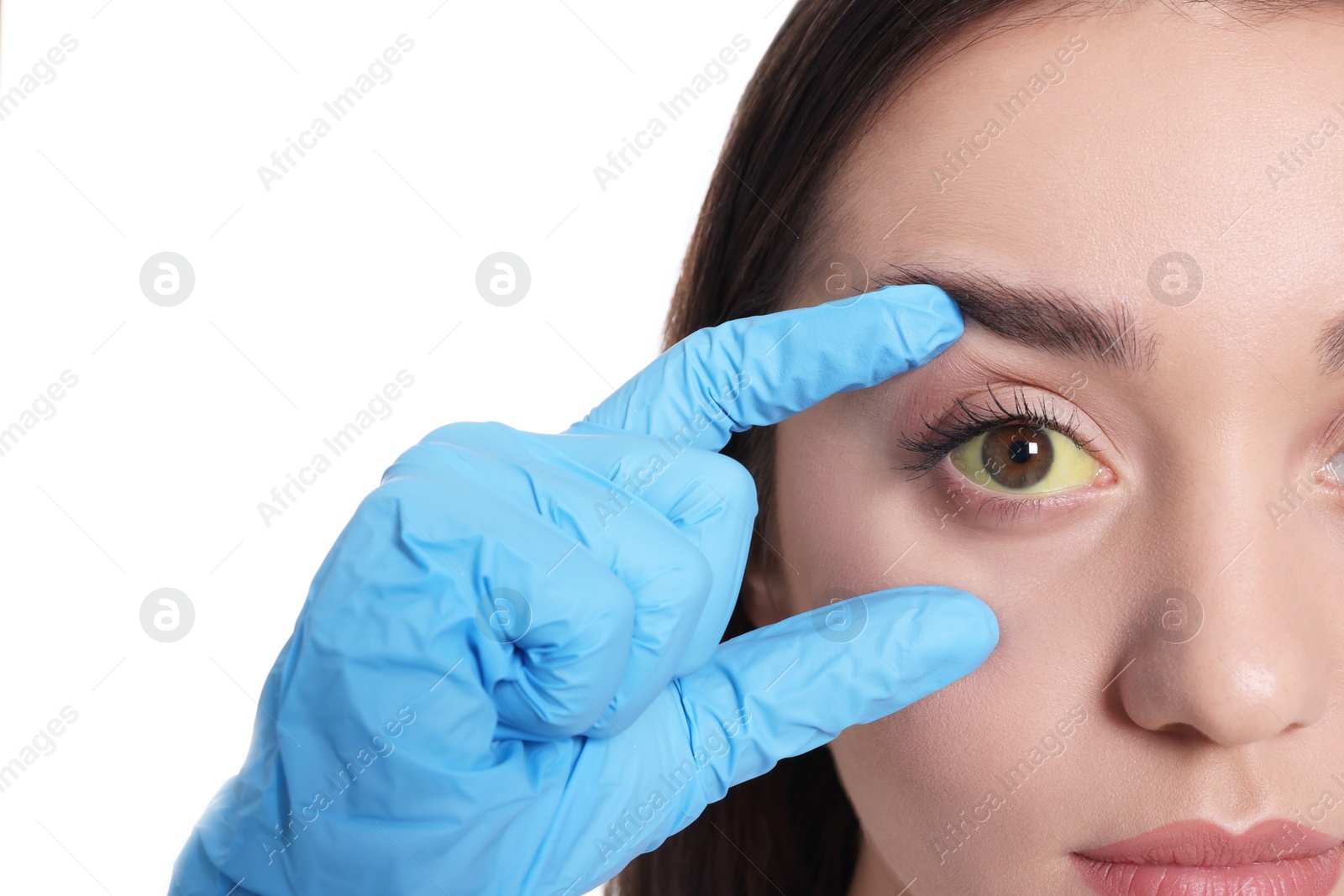 Photo of Doctor checking woman with yellow eyes on white background, closeup. Symptom of hepatitis