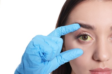 Doctor checking woman with yellow eyes on white background, closeup. Symptom of hepatitis