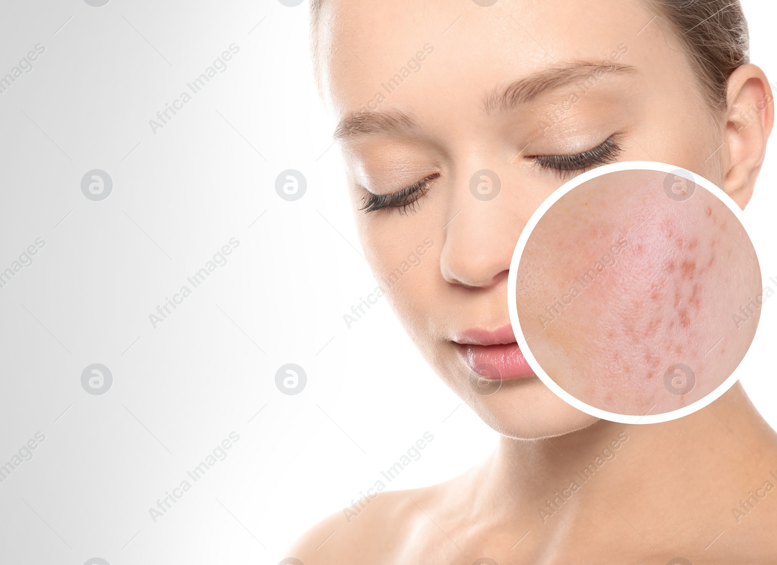 Image of Woman with acne on her face on light background, space for text. Zoomed area showing problem skin